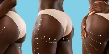 La République du BBL: Entre Fesses de Luxe et Cliniques de Fortune, le derrière est devenu un Terrain de Guerre Sociale à Kinshasa